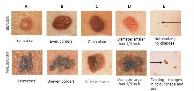 Malignant Melanoma San Mateo Podiatry Group