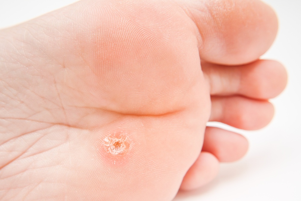 Foot Biopsy Skin Biopsy On Feet Foot Skin Cancer